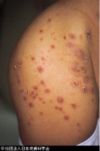 斑点 手足 赤い 皮膚の赤い斑点は病気？かゆみがあるなしでの７つの原因と対処法！